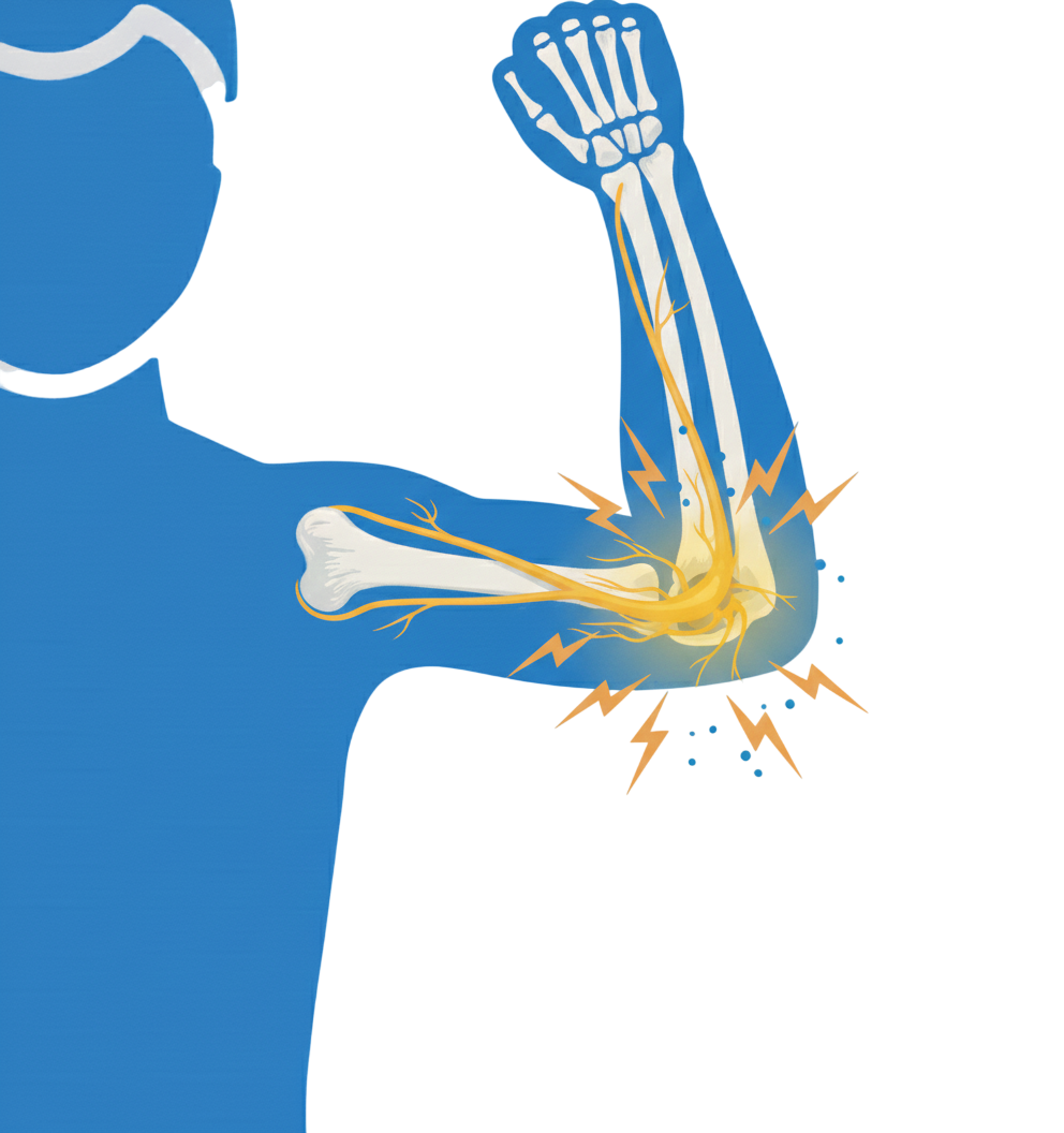 Ulnar Sinir Sıkışması